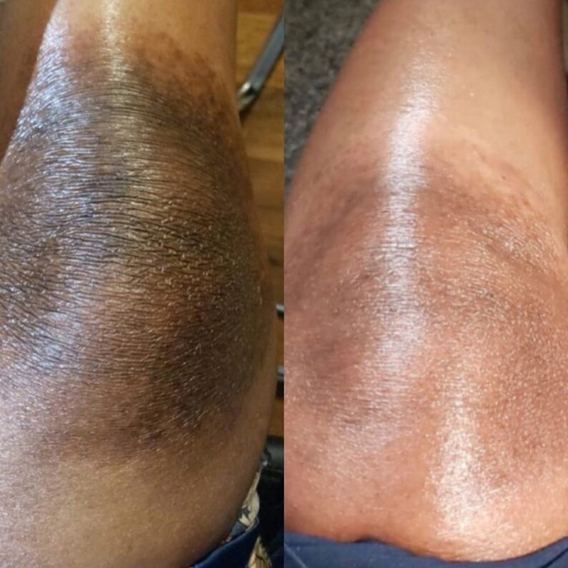 MÔOYAM Dark Knees and Elbows Strong Whitening Cream