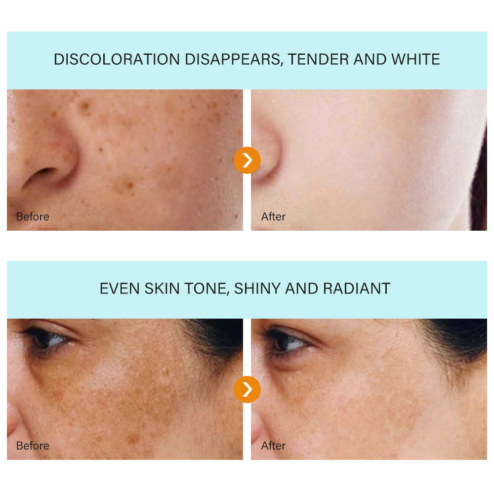 MÔOYAM Strong Effective Freckle Cream Removal Cream