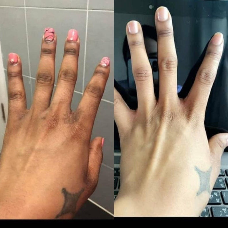 MÔOYAM Get Rid of Dark Knuckles in 7 Days Serum for Elbow and Knees and Knuckles