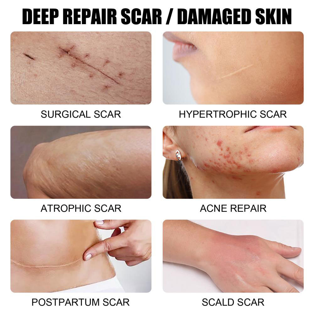 MÔOYAM Fastest Acne Scar & Stretch mark Removal Cream