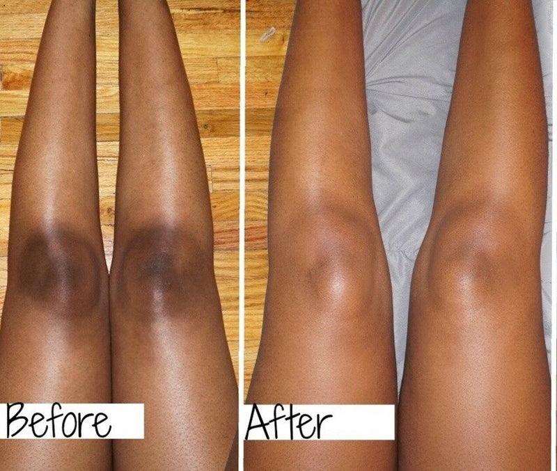 MÔOYAM Dark Knees and Elbows Strong Whitening Cream