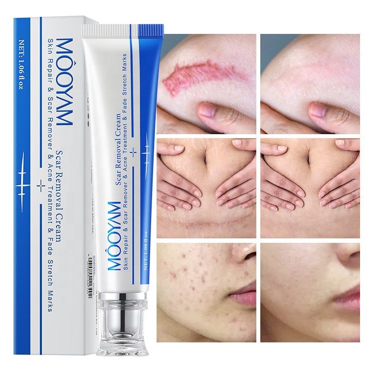 MÔOYAM Fastest Acne Scar & Stretch mark Removal Cream