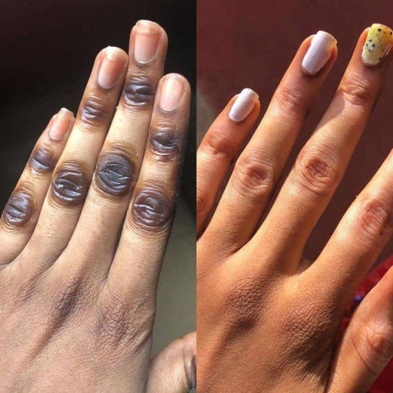 MÔOYAM Get Rid of Dark Knuckles in 7 Days Serum for Elbow and Knees and Knuckles