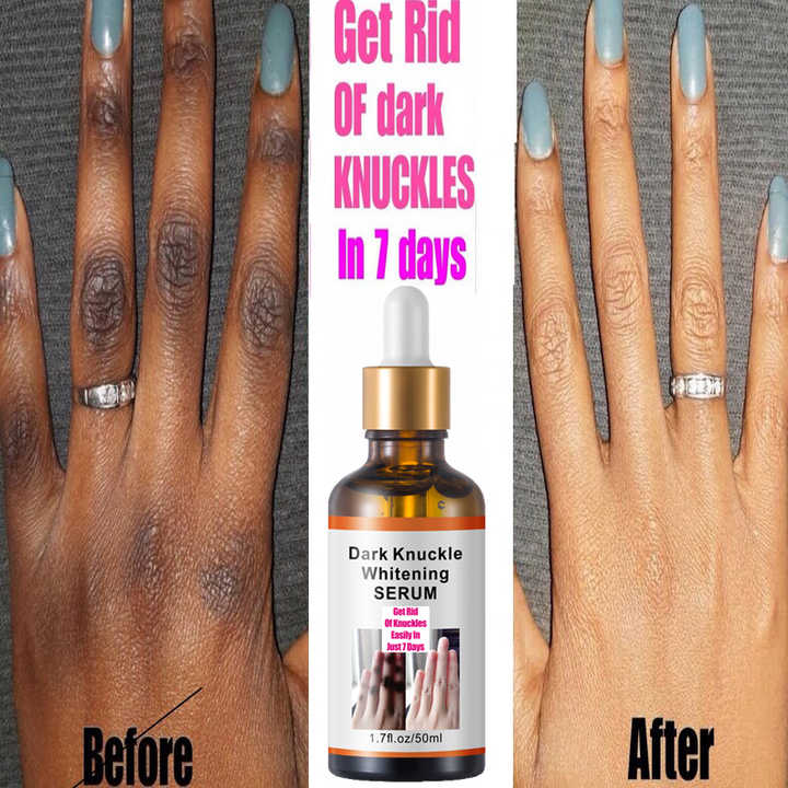 MÔOYAM Get Rid of Dark Knuckles in 7 Days Serum for Elbow and Knees and Knuckles