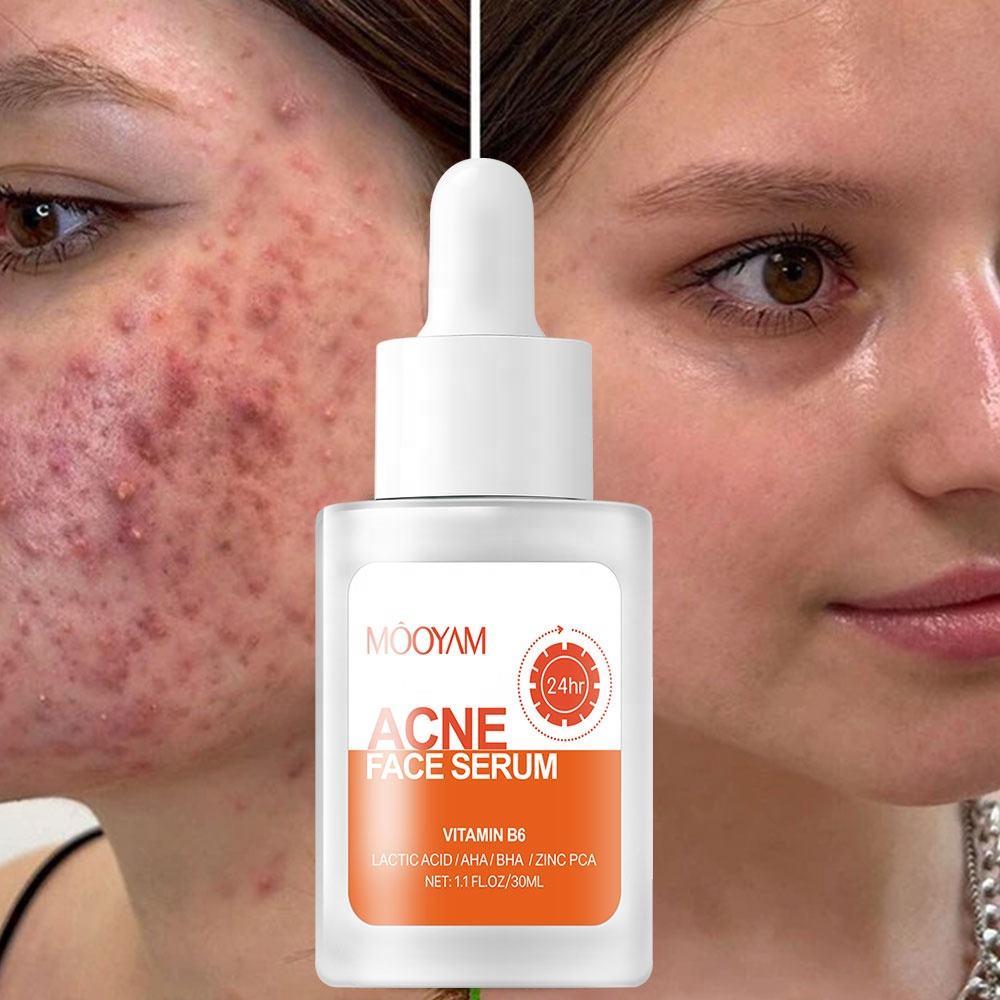 MÔOYAM Anti Acne Face Serum For Smooth Skin