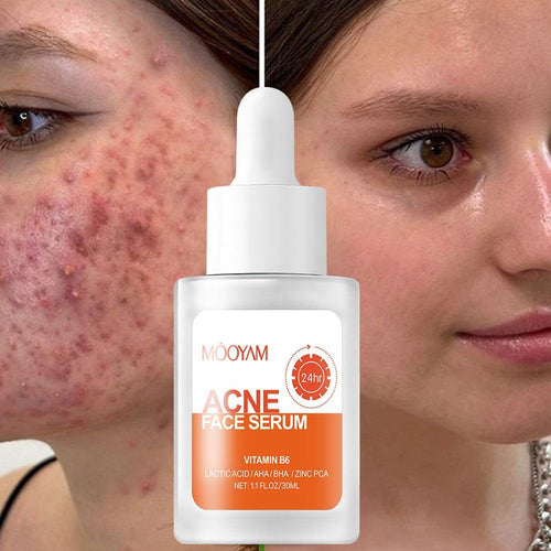 MÔOYAM Anti Acne Face Serum For Smooth Skin